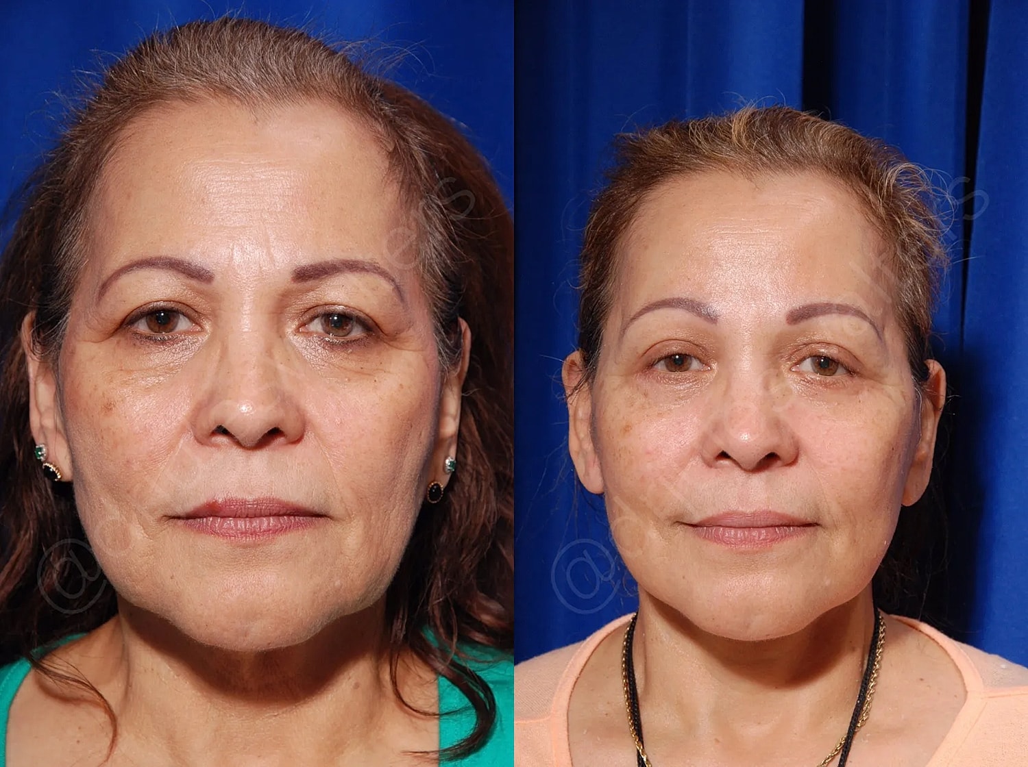 Before and after facial treatment comparison.