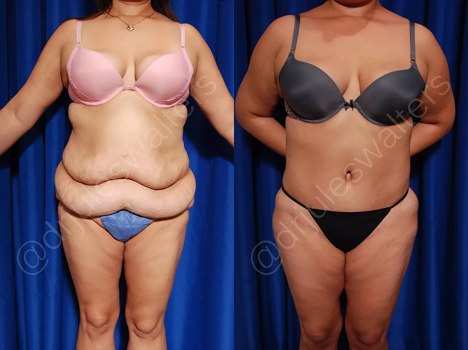 Before and after body transformation comparison.