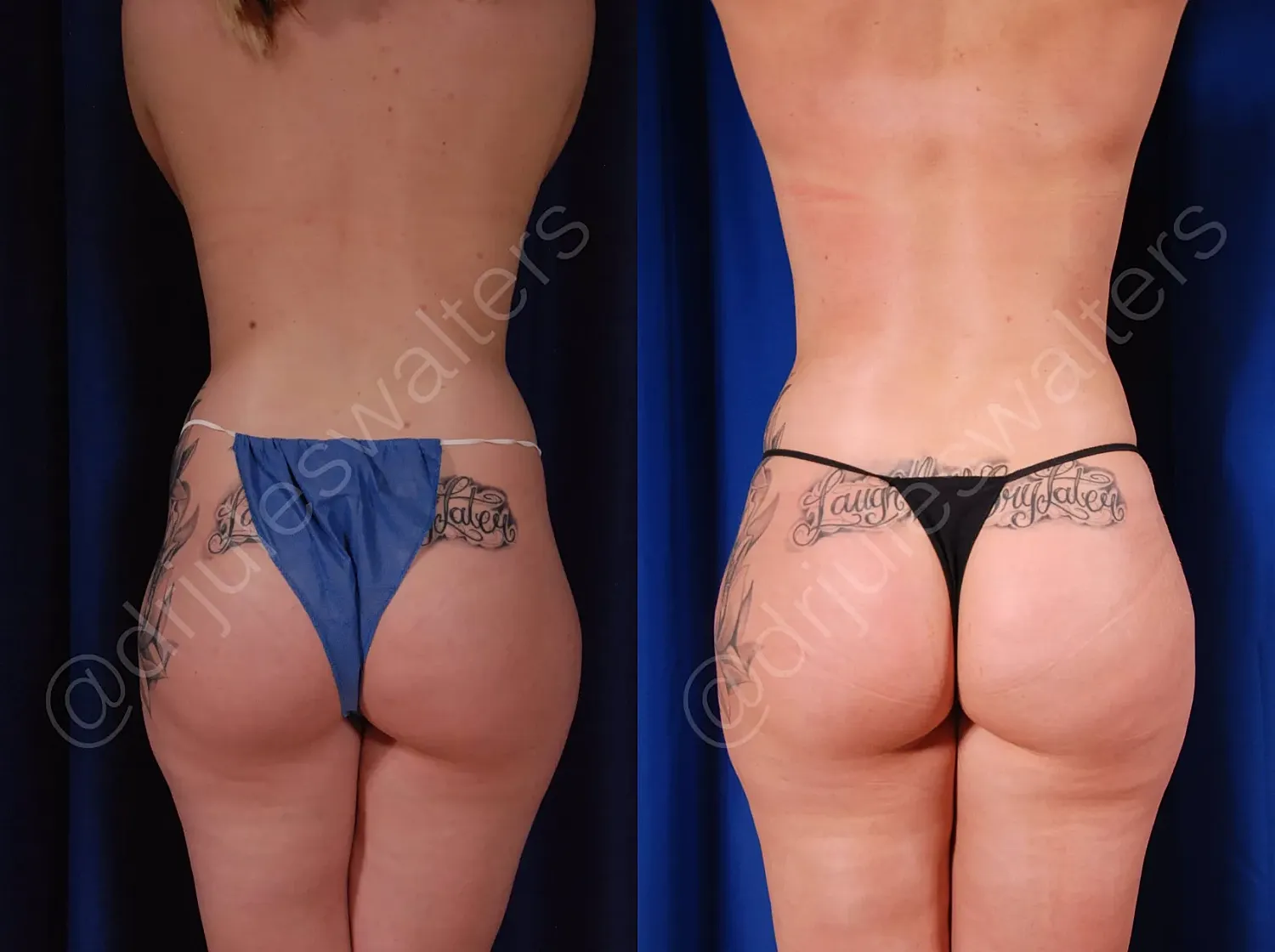 Comparison of two thong styles on a model.