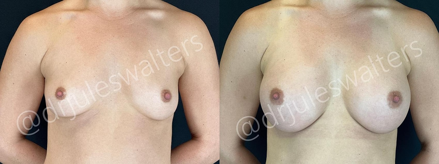Before and after breast enhancement photos.