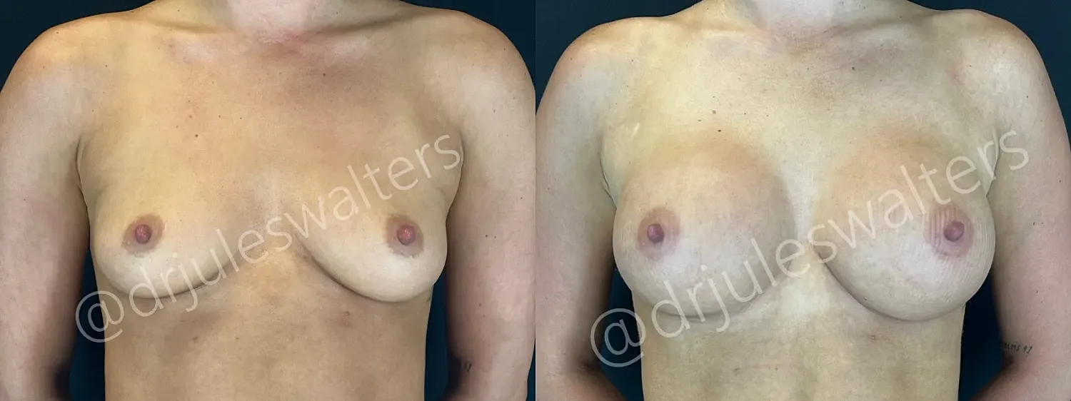 Before and after breast enhancement comparison image.