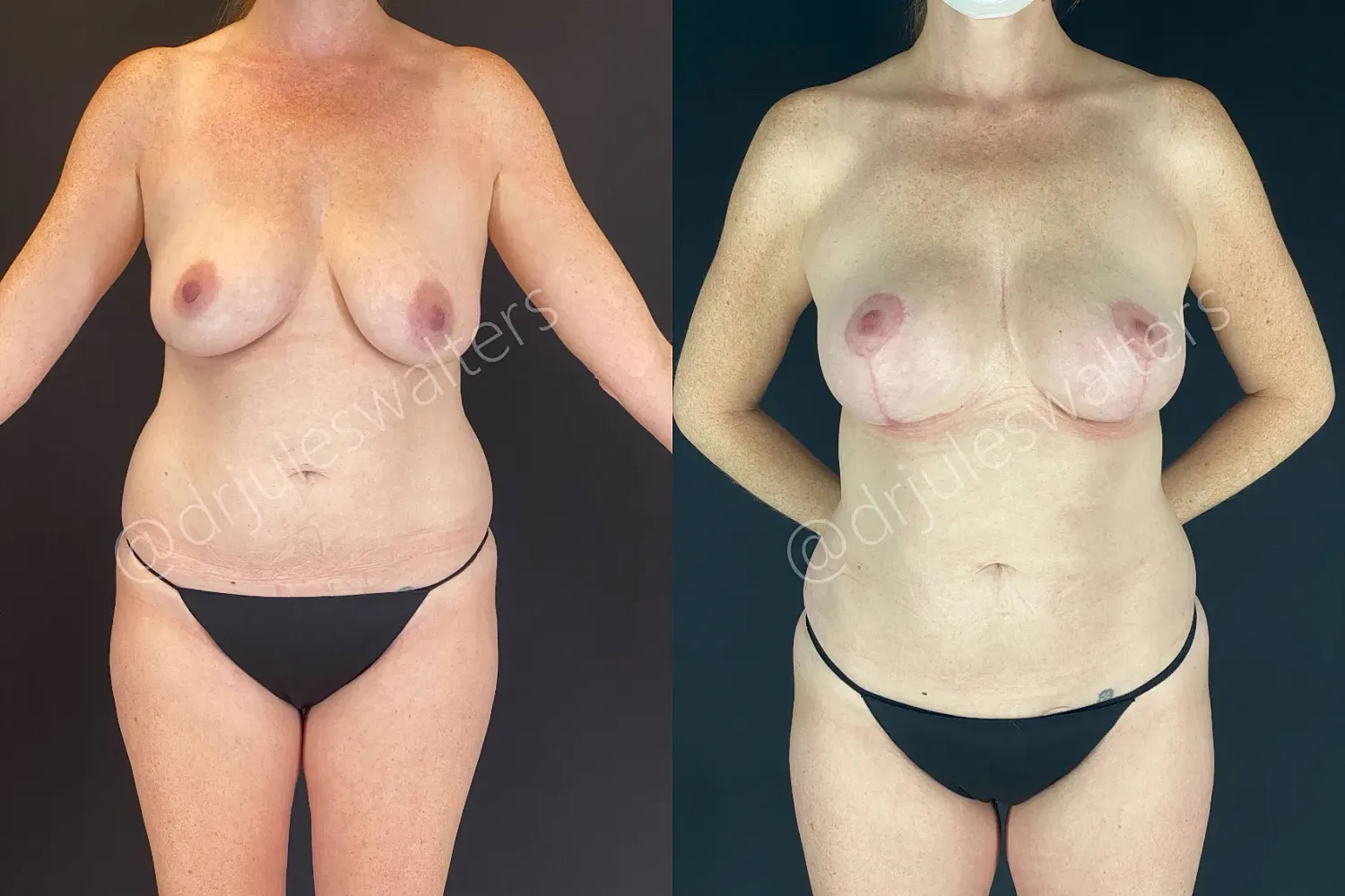 Before and after body transformation photos.