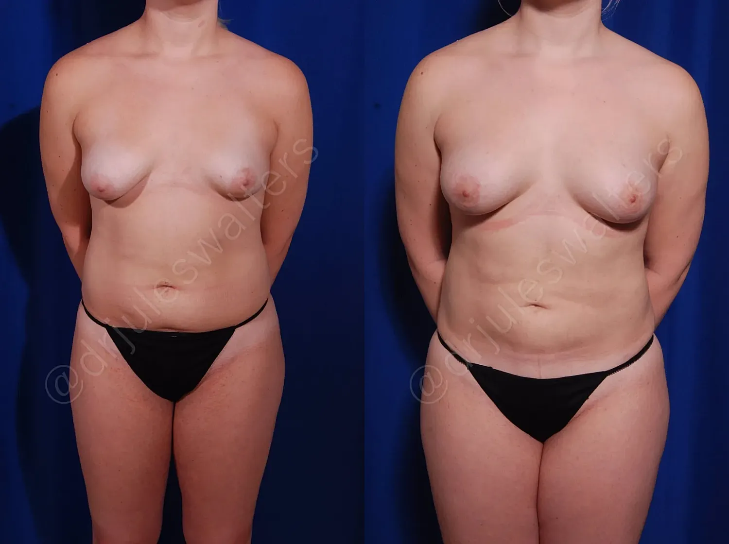 Front and side views of a female torso.