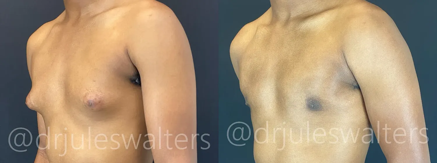Post-surgery chest appearance comparison before and after.