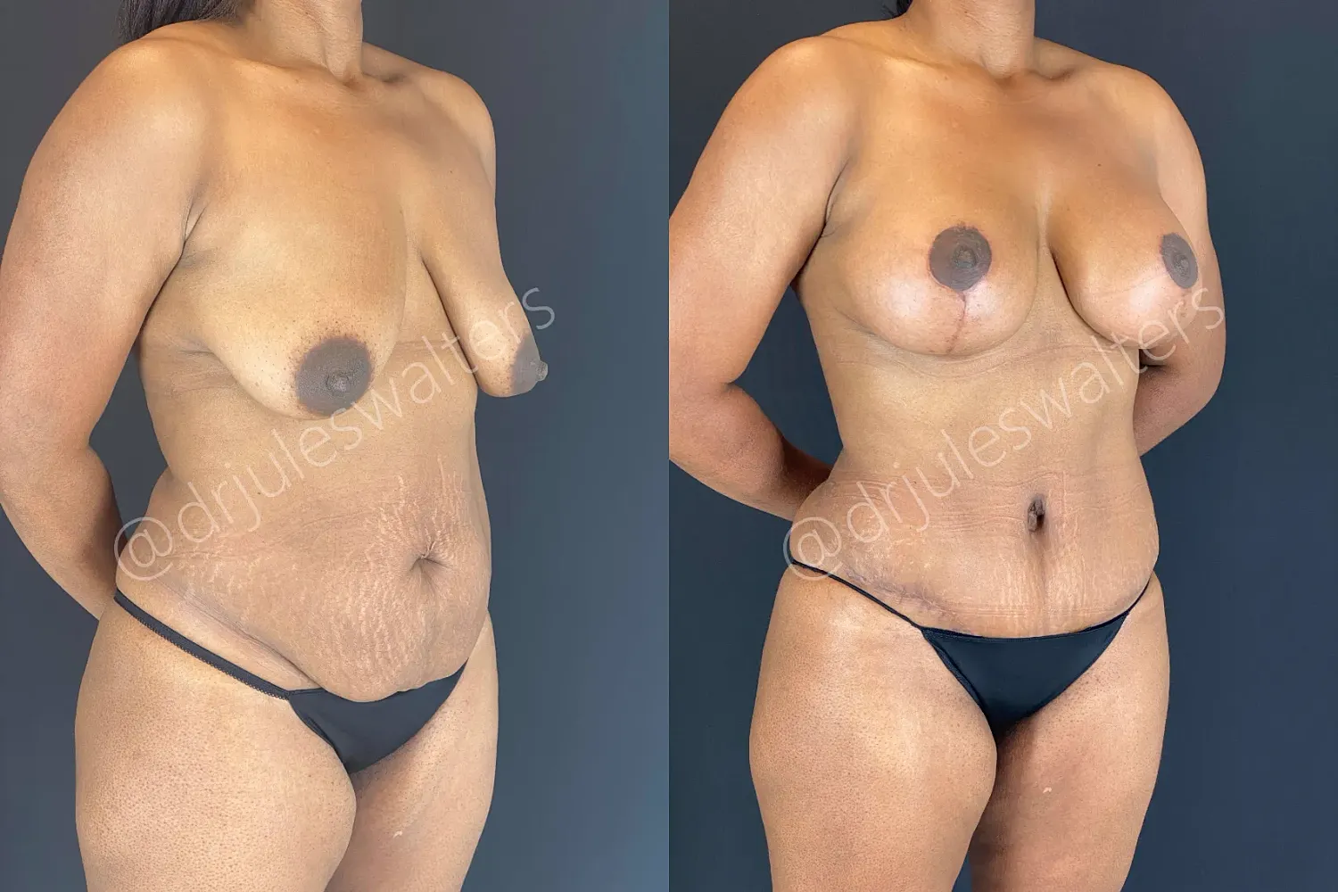 Breast augmentation before and after transformation.