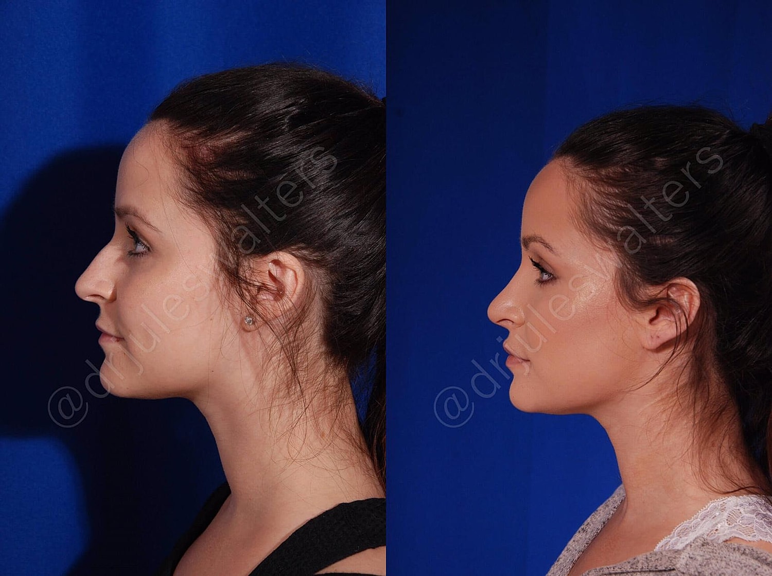 Profile comparison of a woman's facial features.