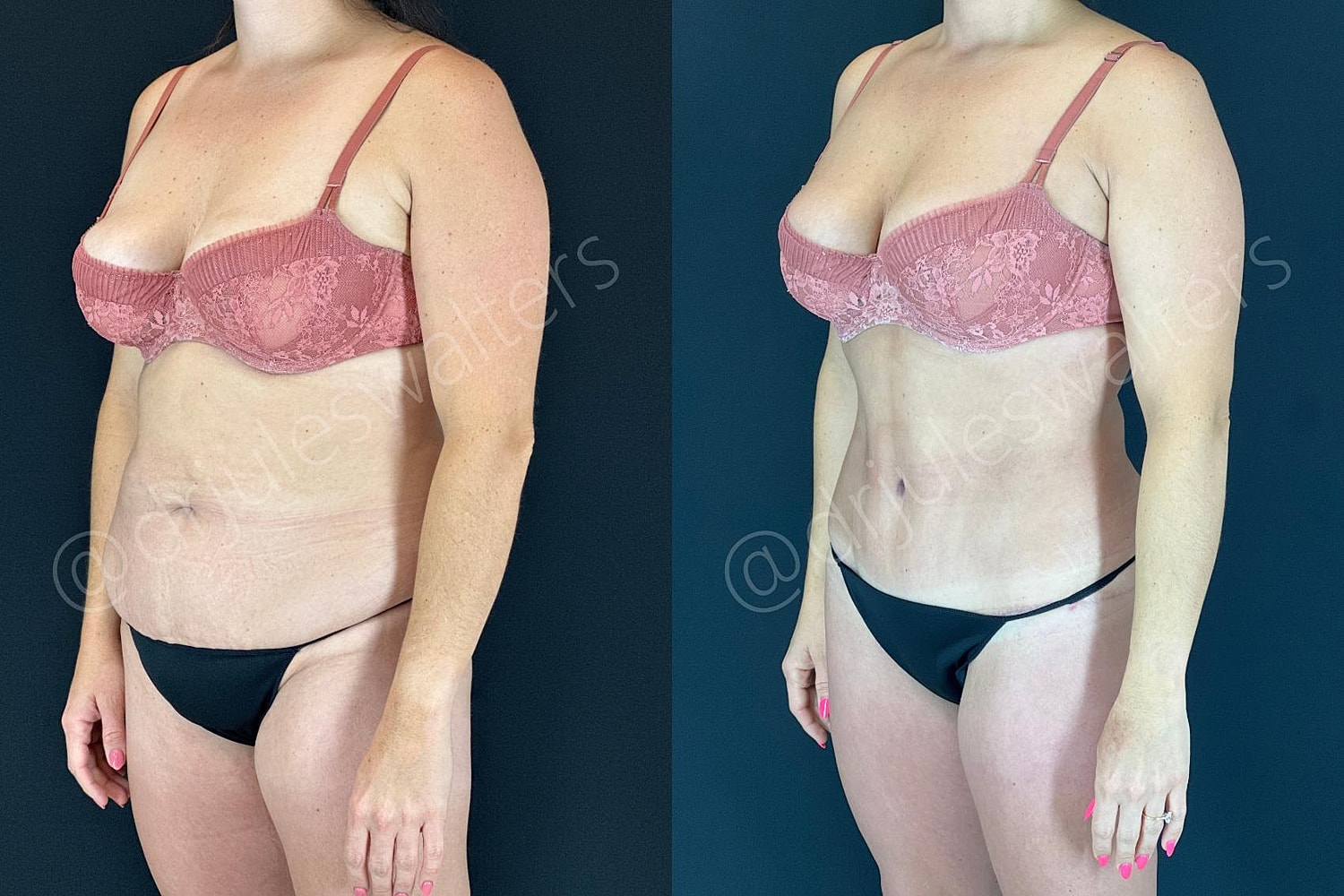 Before and after body transformation comparison.