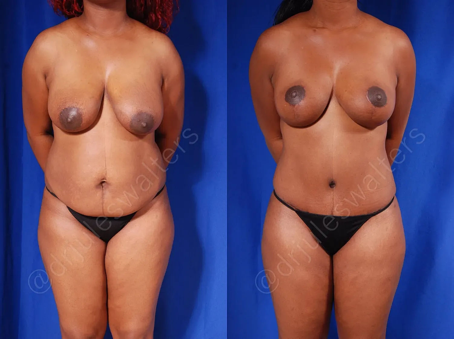 Before and after body comparison of a woman.