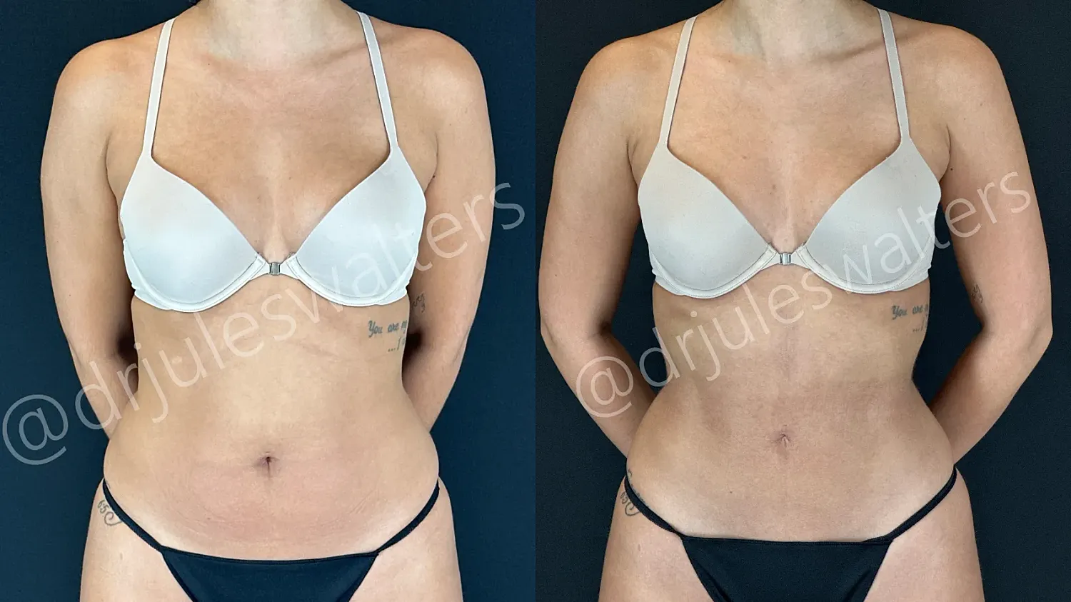 Before and after body sculpting treatment comparison.