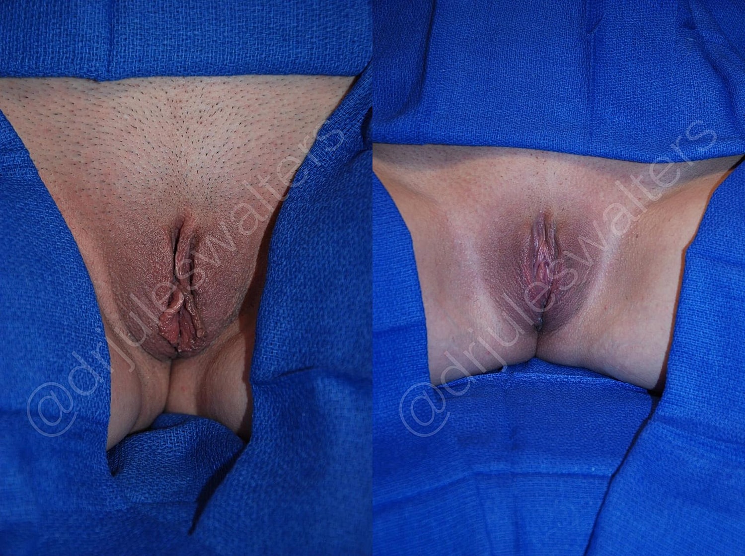 Labiaplasty Before & After