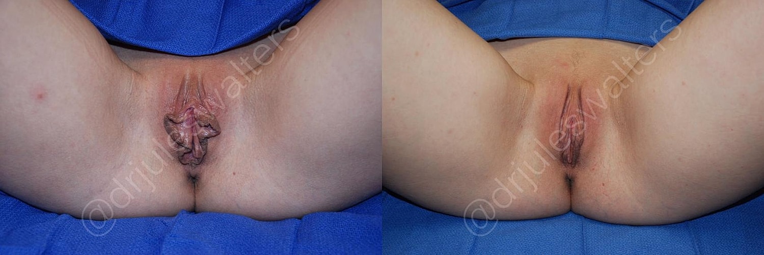 Labiaplasty Before & After