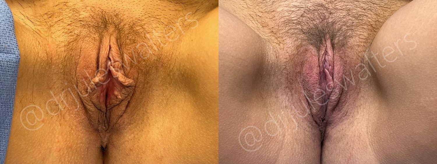 Labiaplasty Before & After