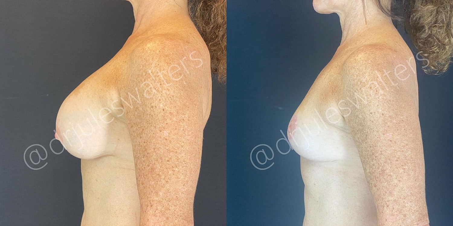 Breast Revision Before & After