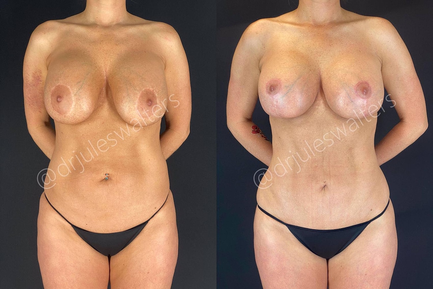 Breast Revision Before & After