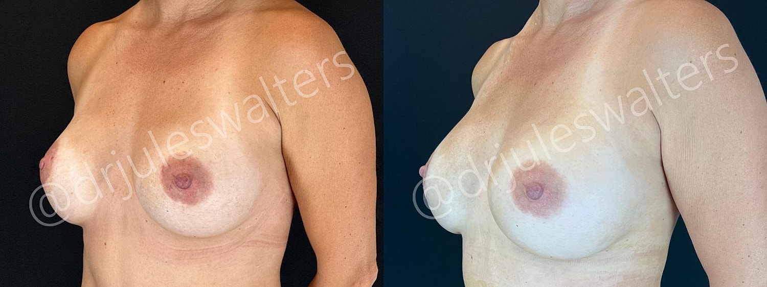 Breast Revision Before & After