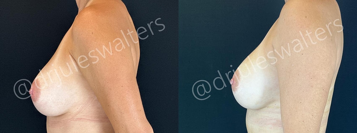 Breast Revision Before & After
