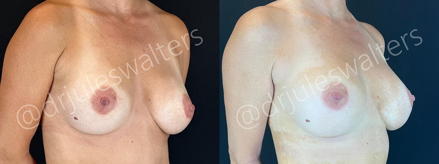 Breast Revision Before & After