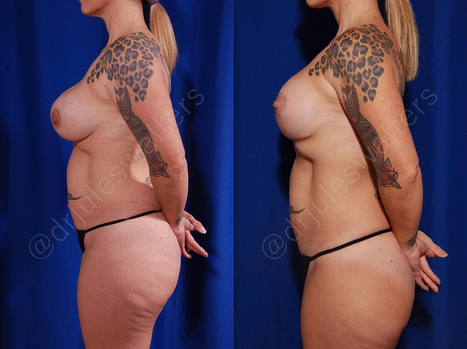 Breast Revision Before & After