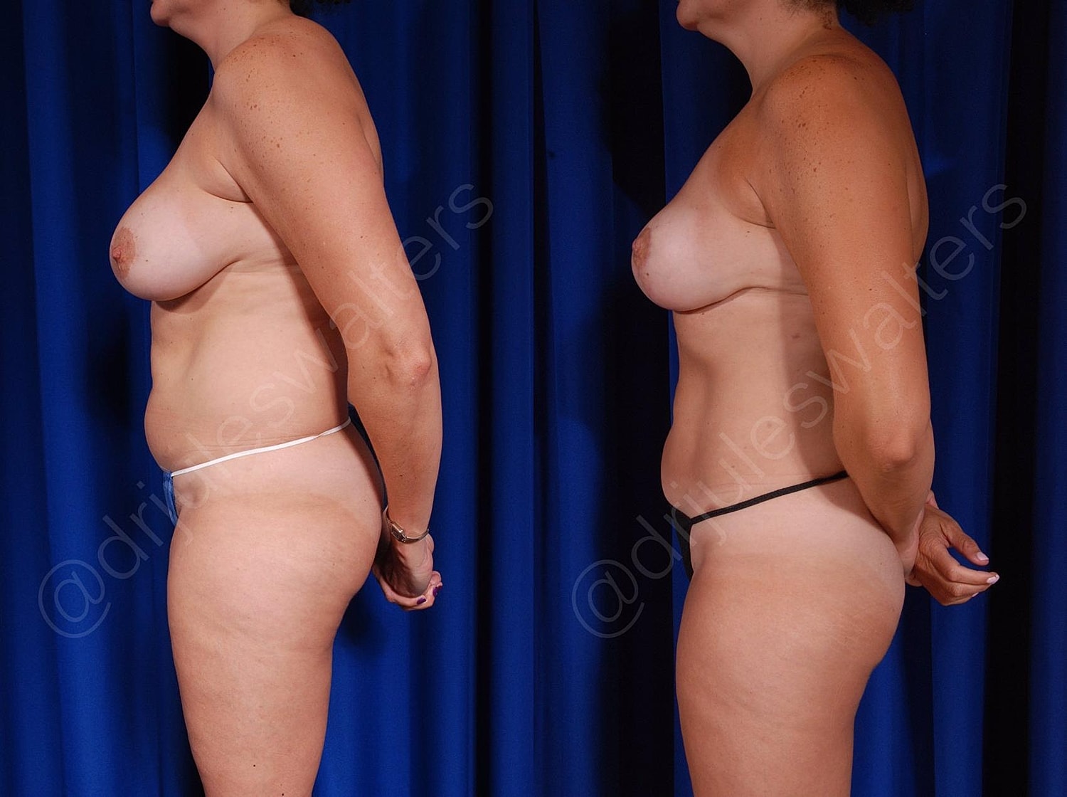 Breast Revision Before & After