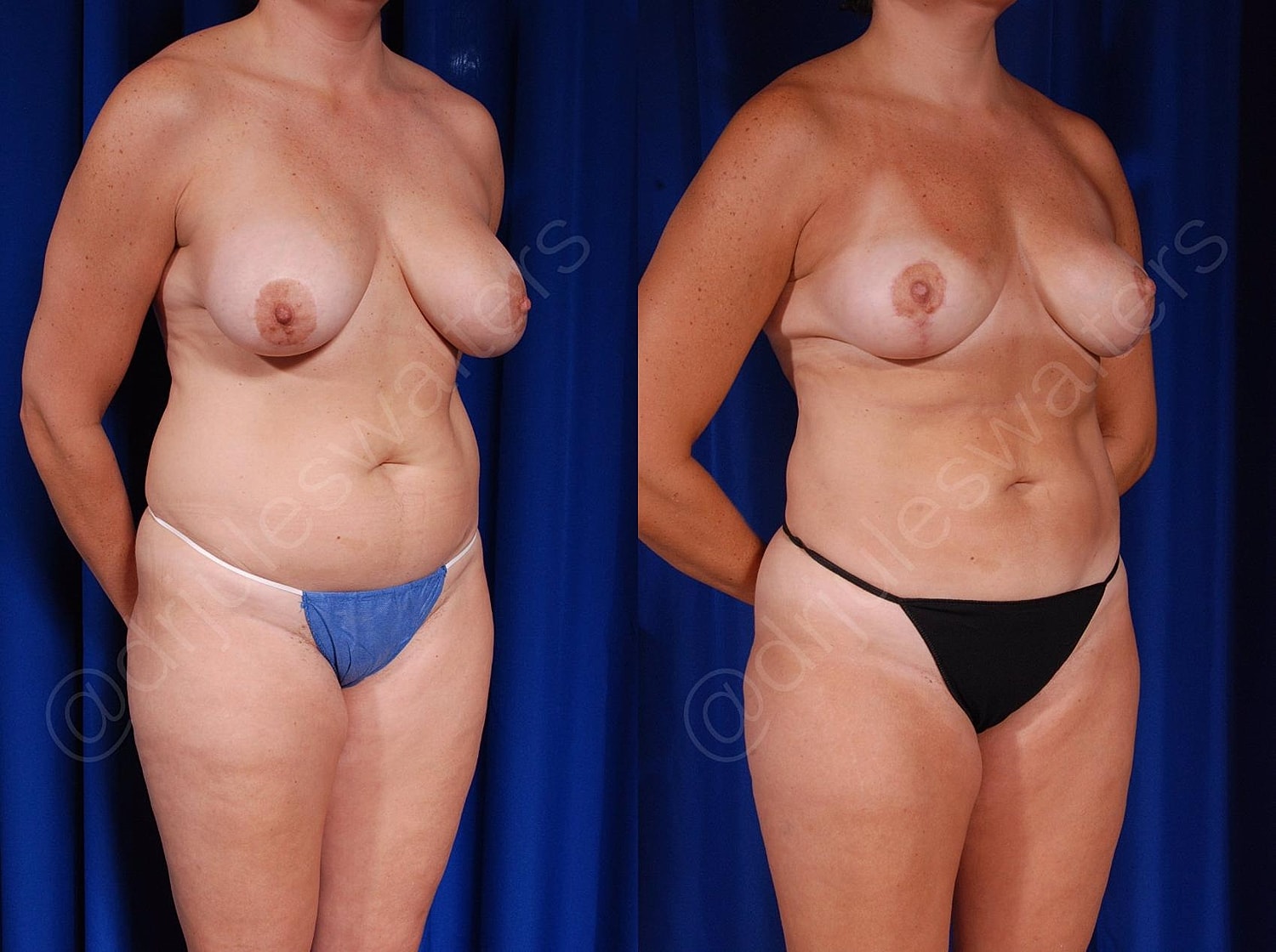 Breast Revision Before & After