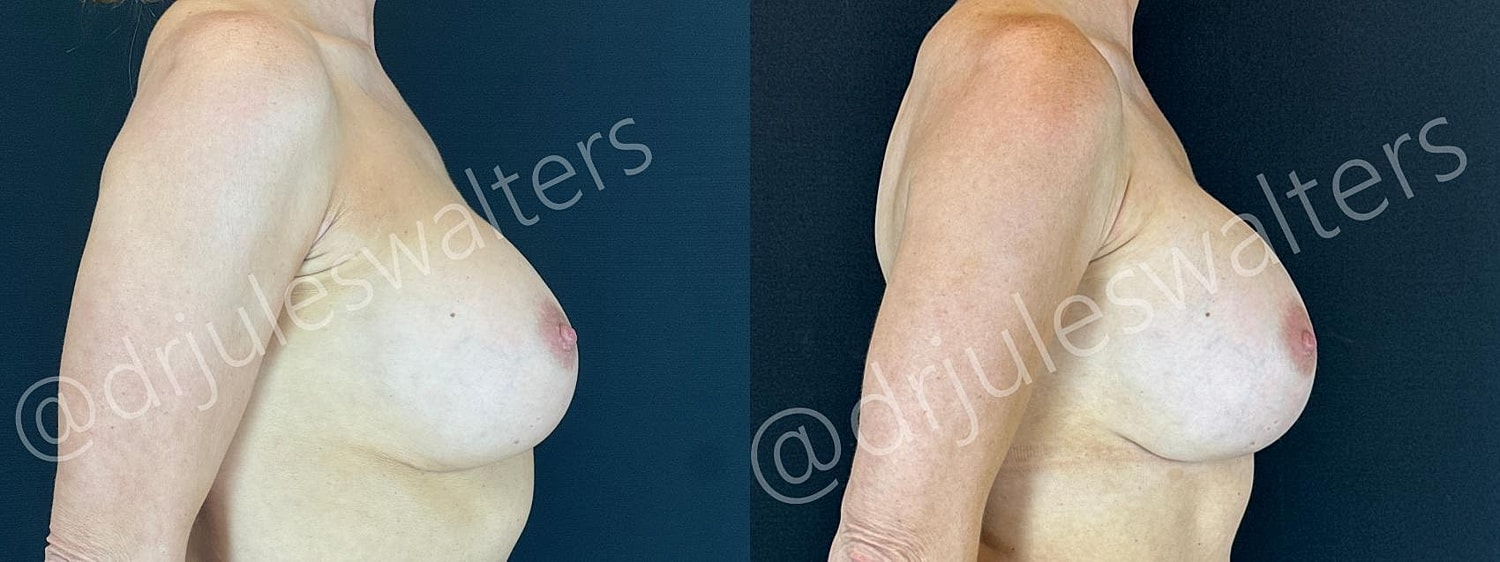 Breast Revision Before & After