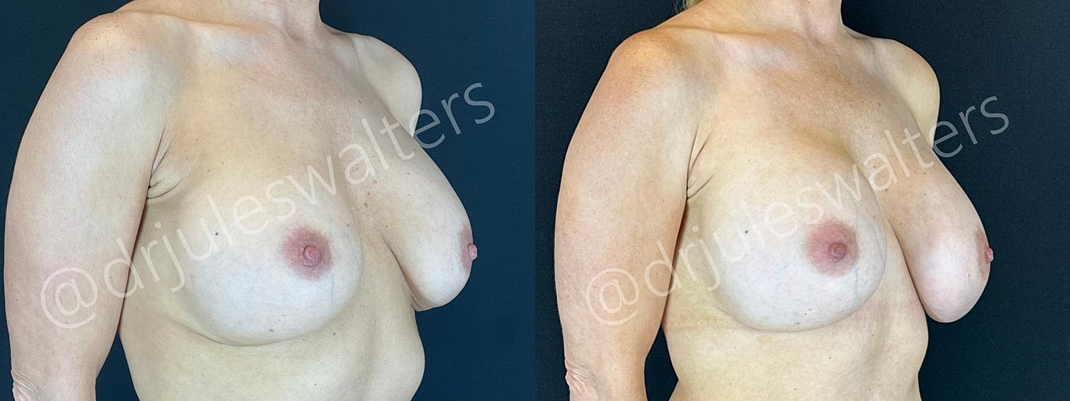 Breast Revision Before & After