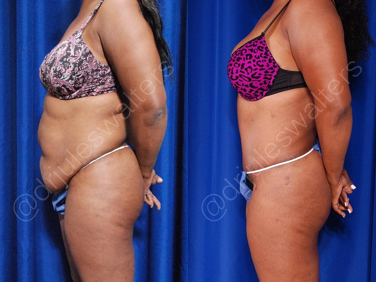 Liposuction Before & After