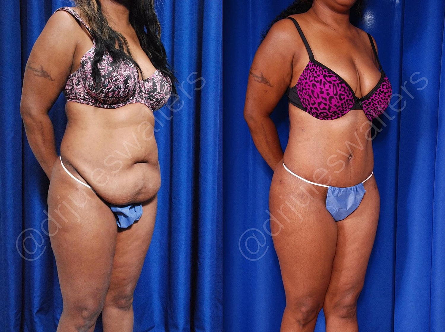 Liposuction Before & After