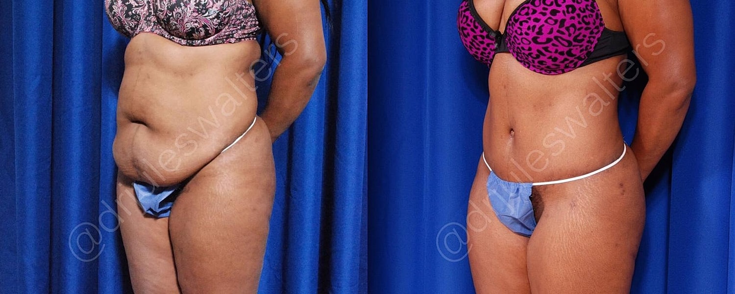 Liposuction Before & After