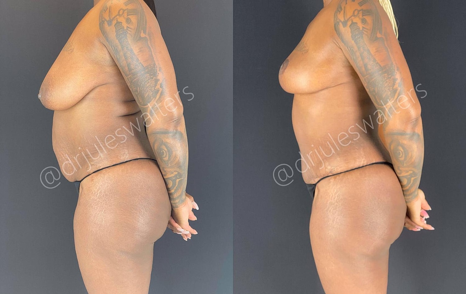 Liposuction Before & After