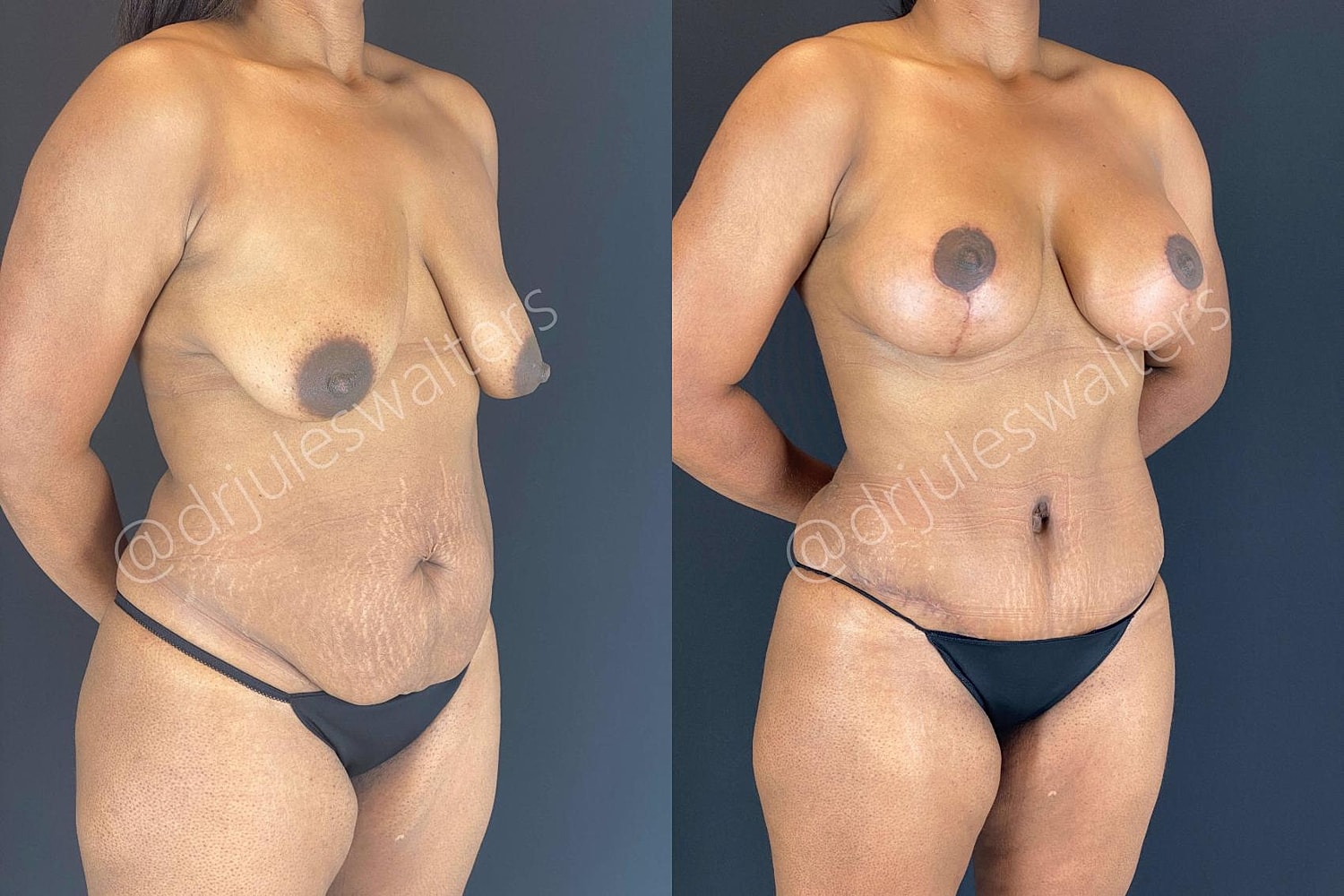 Liposuction Before & After