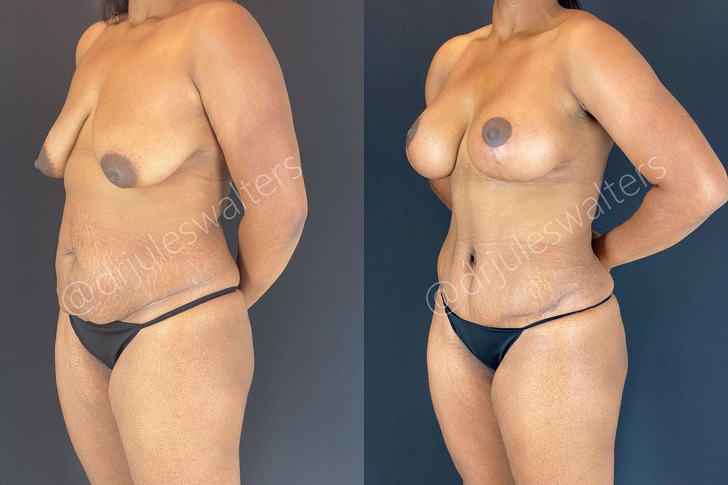 Liposuction Before & After