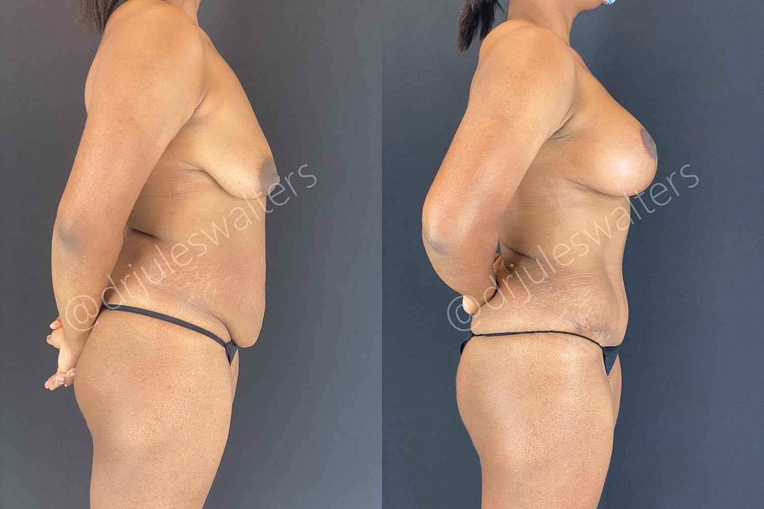 Liposuction Before & After