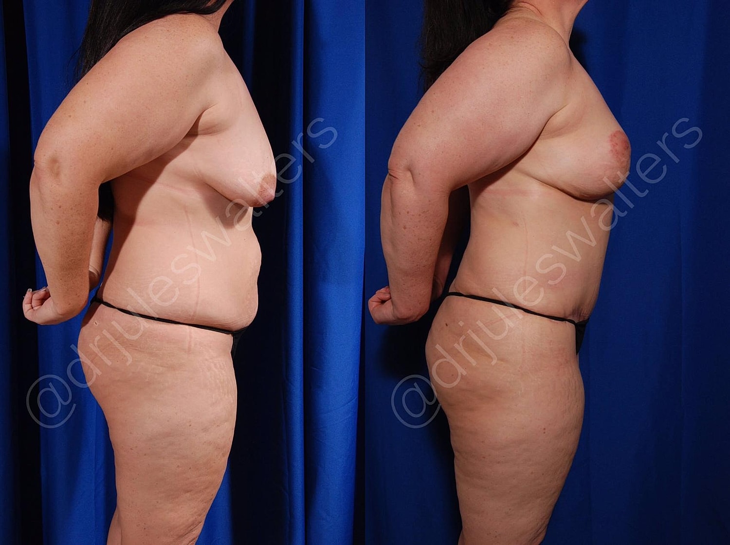 Liposuction Before & After