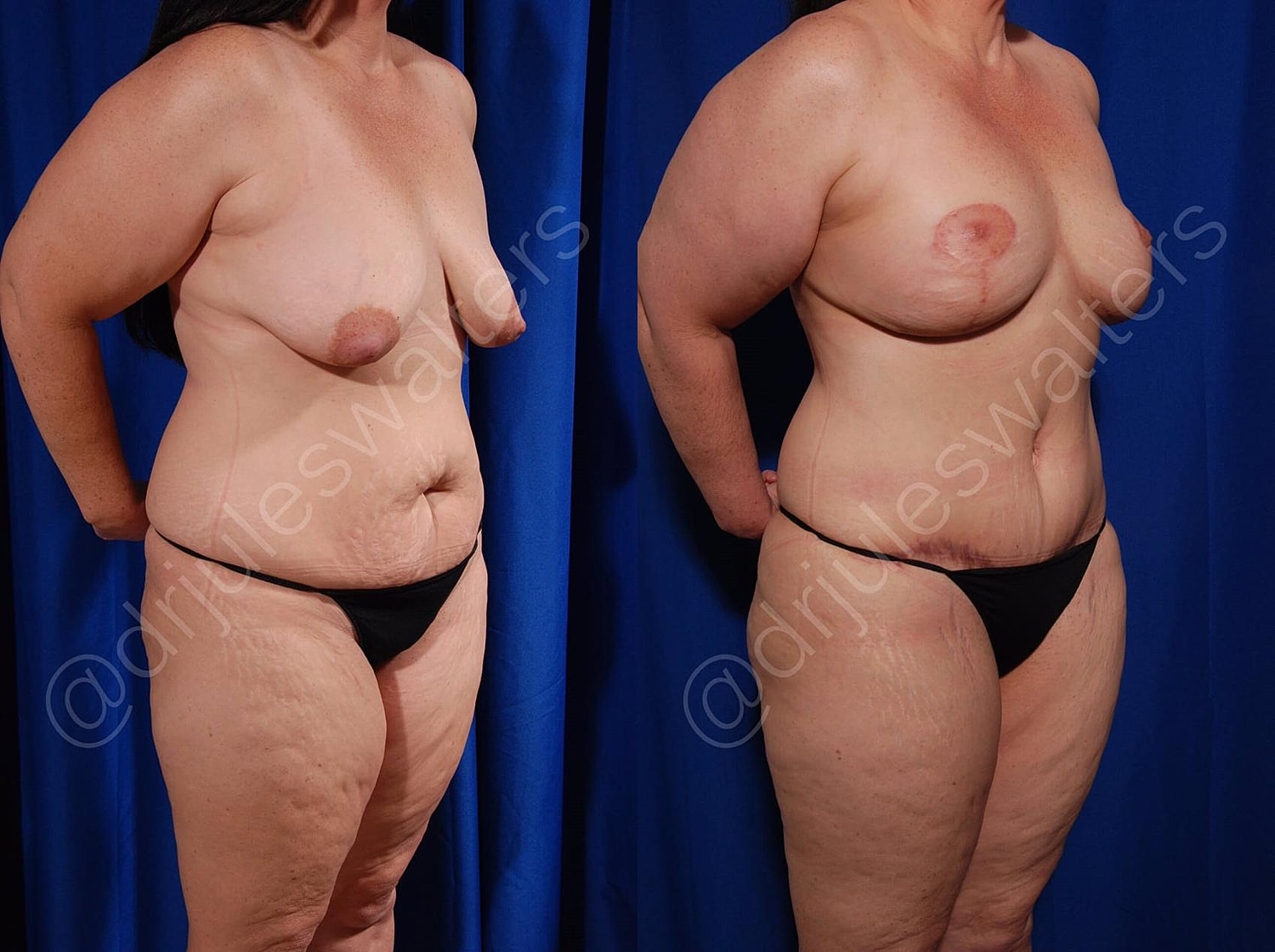 Liposuction Before & After