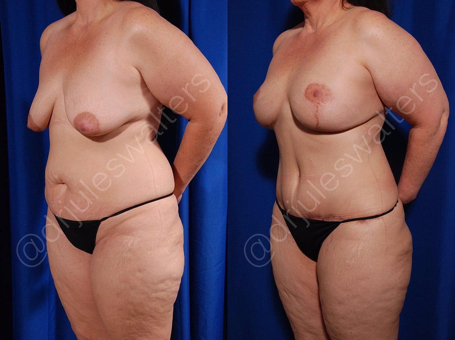 Liposuction Before & After