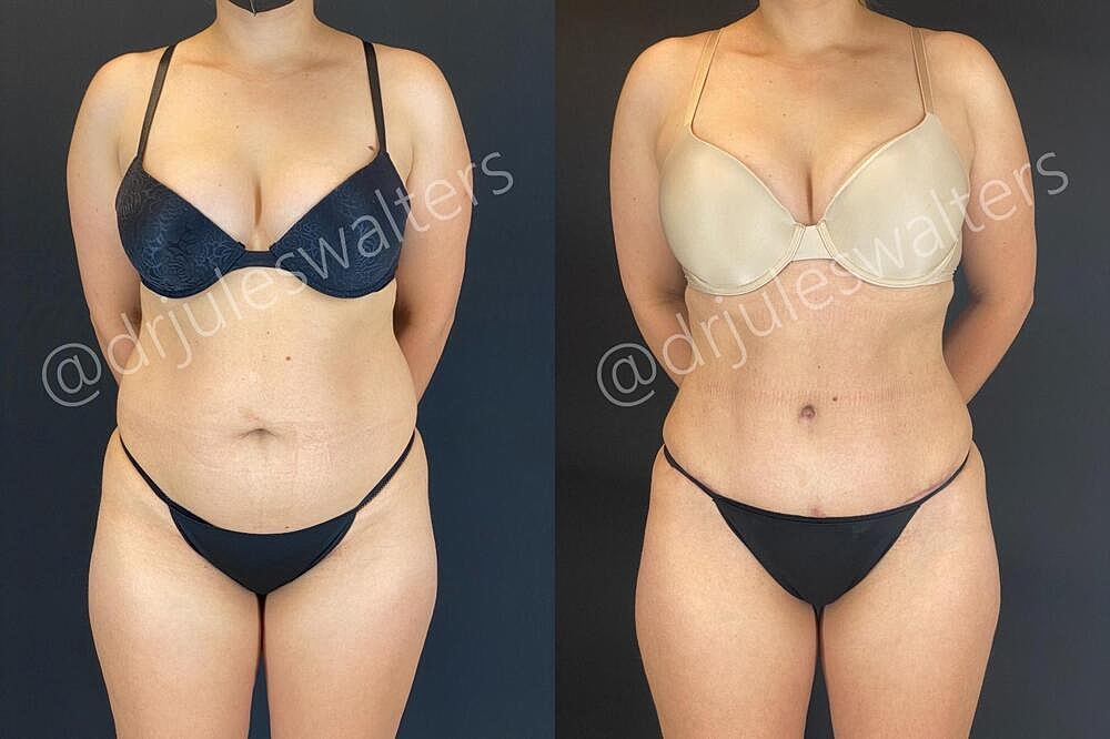 Liposuction Before & After