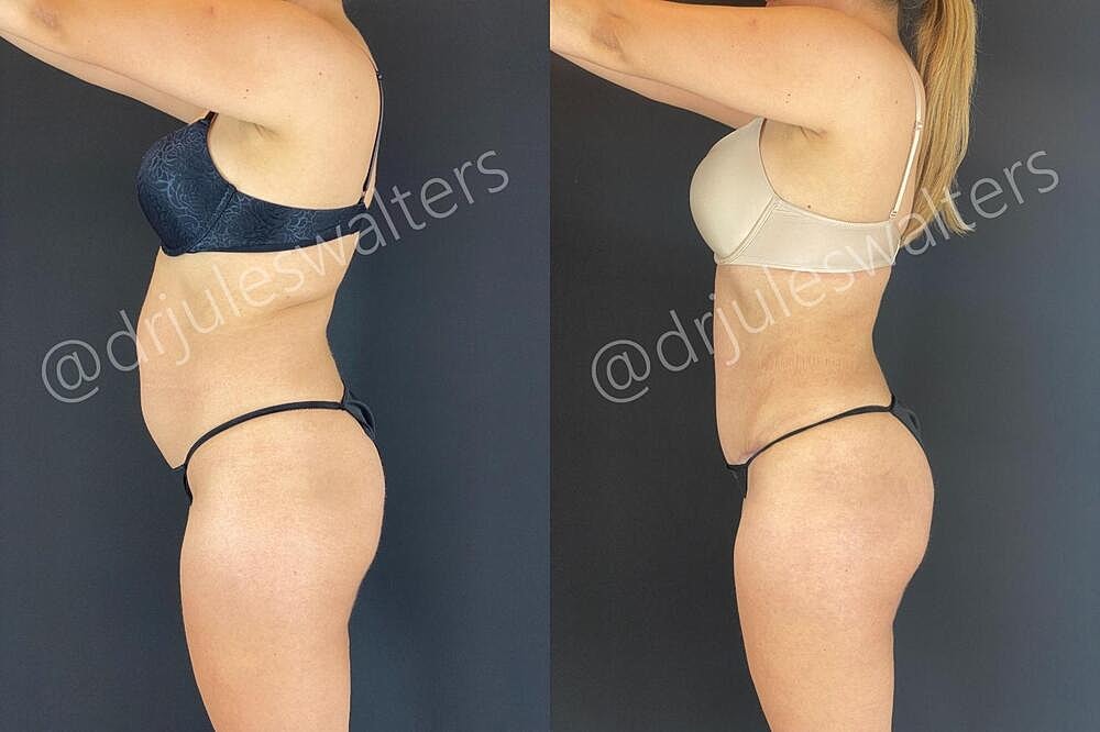 Liposuction Before & After