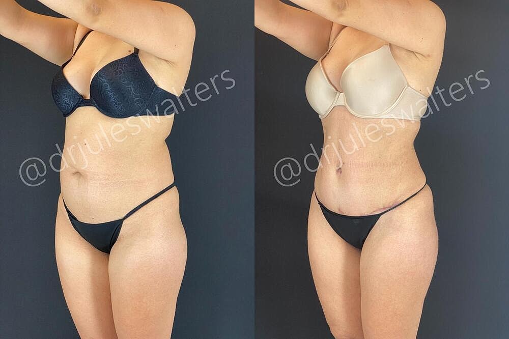 Liposuction Before & After