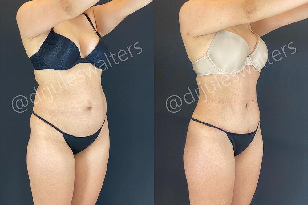 Liposuction Before & After