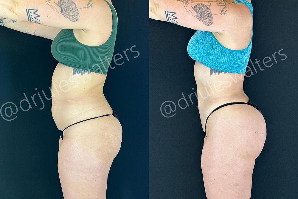 Liposuction Before & After