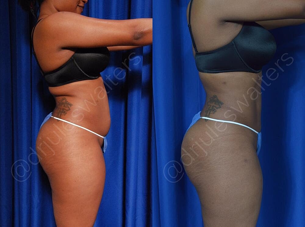 Liposuction Before & After