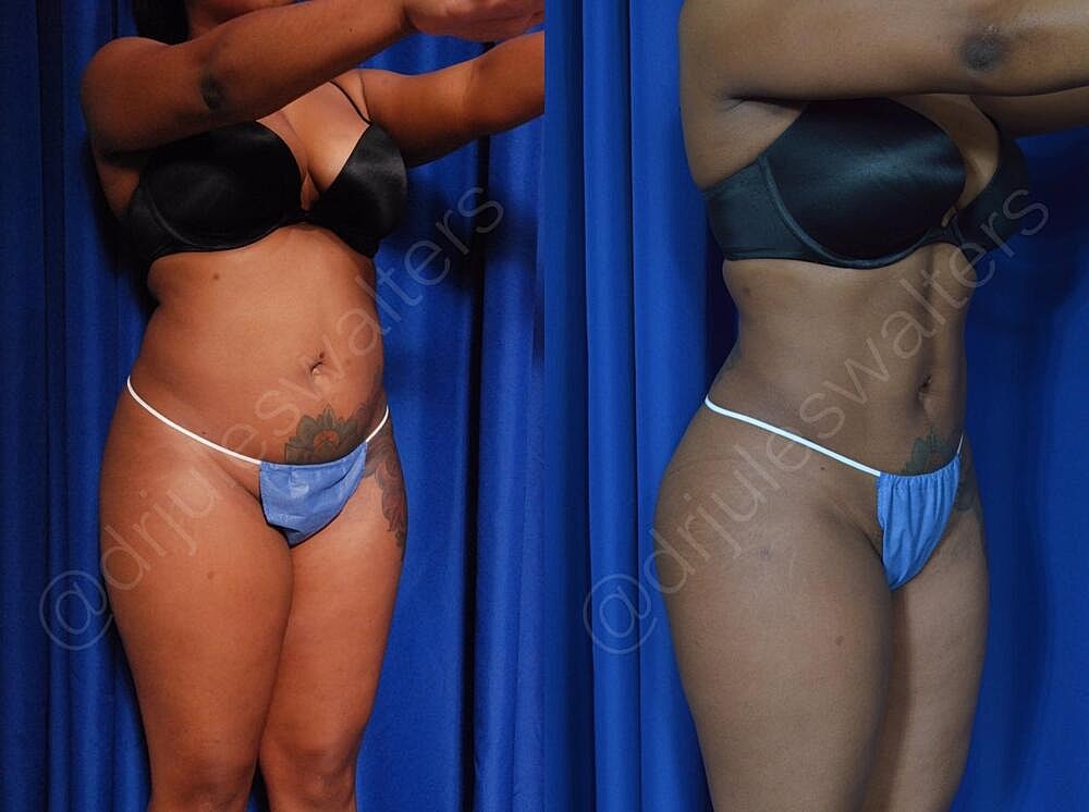 Liposuction Before & After