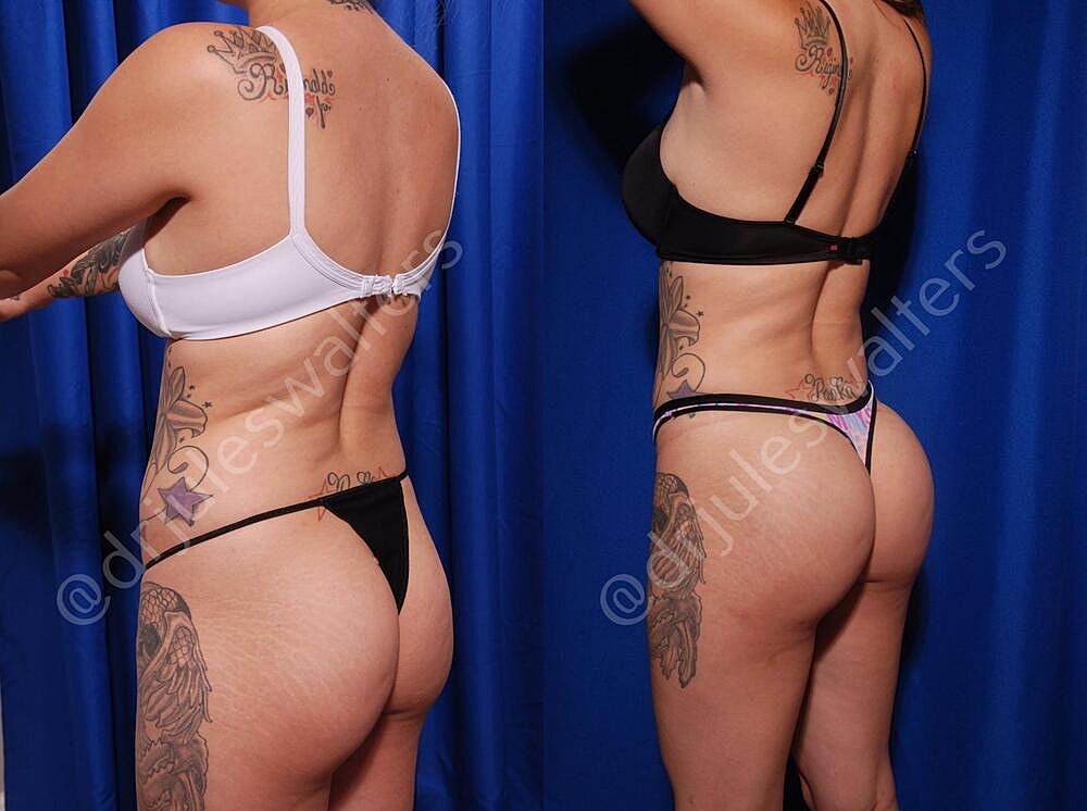 Liposuction Before & After