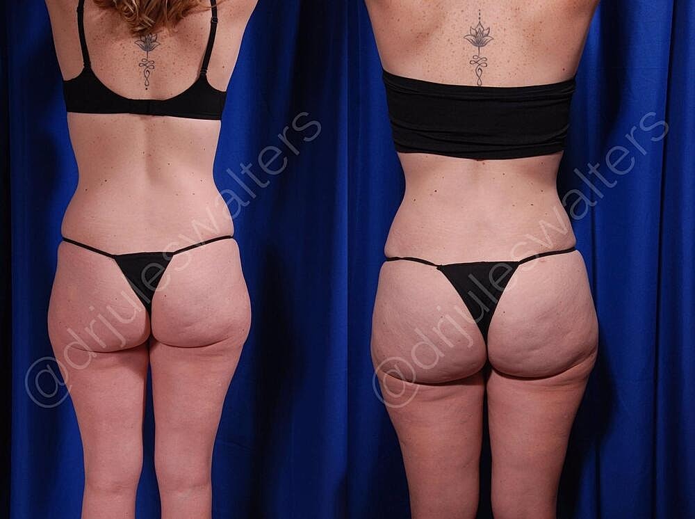 Liposuction Before & After