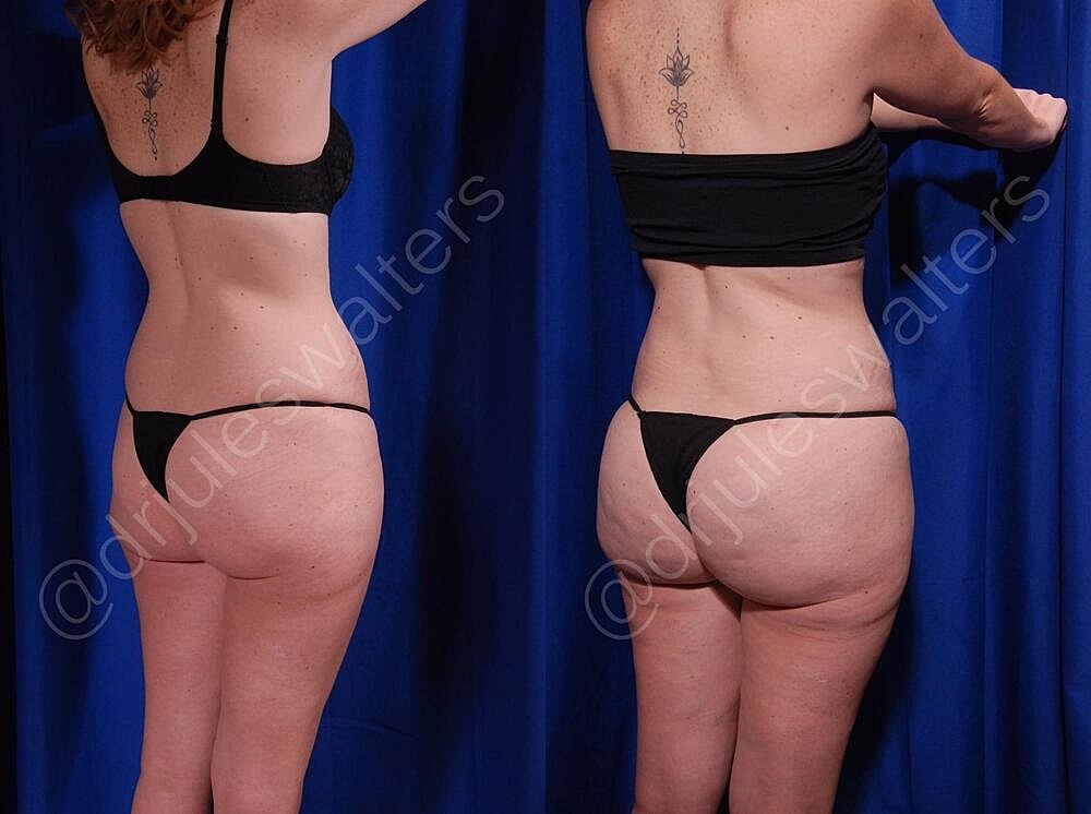 Liposuction Before & After