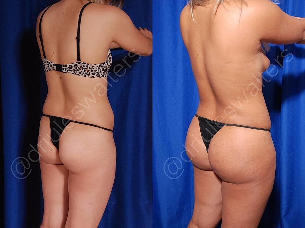 Liposuction Before & After