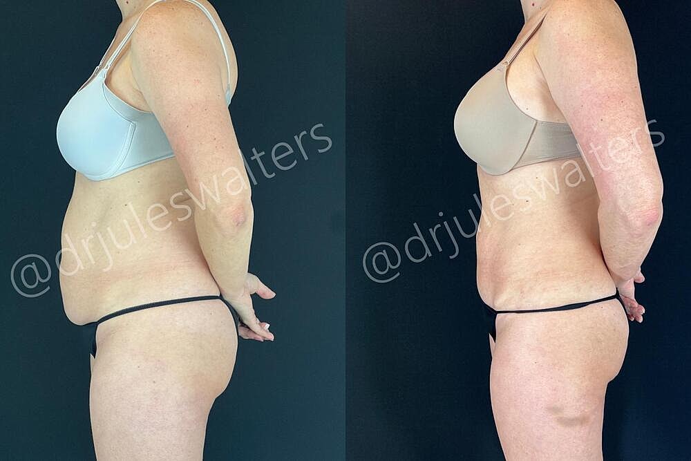 Liposuction Before & After