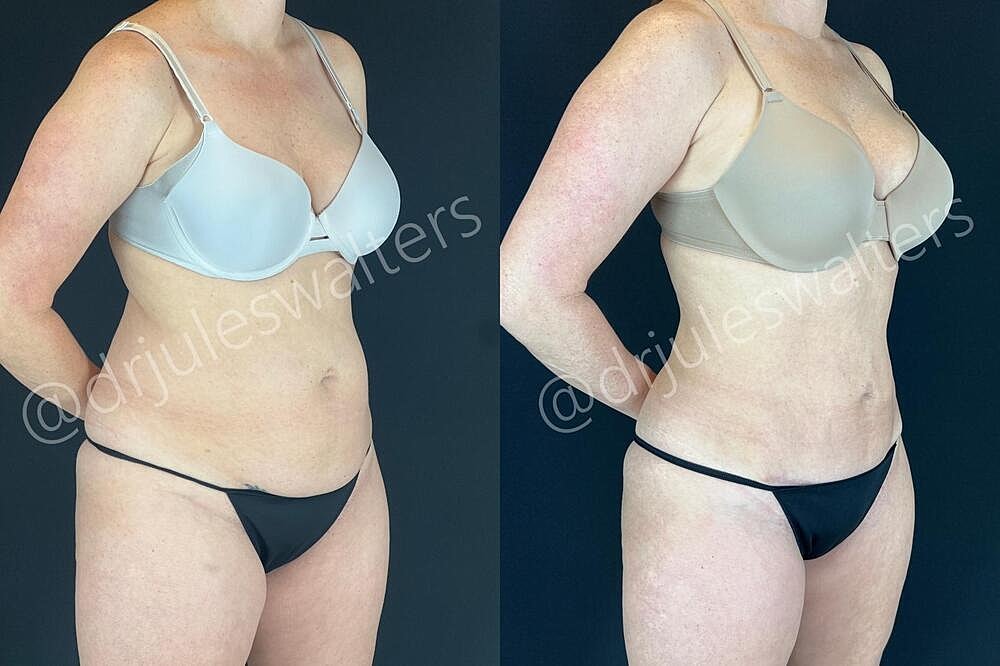 Liposuction Before & After