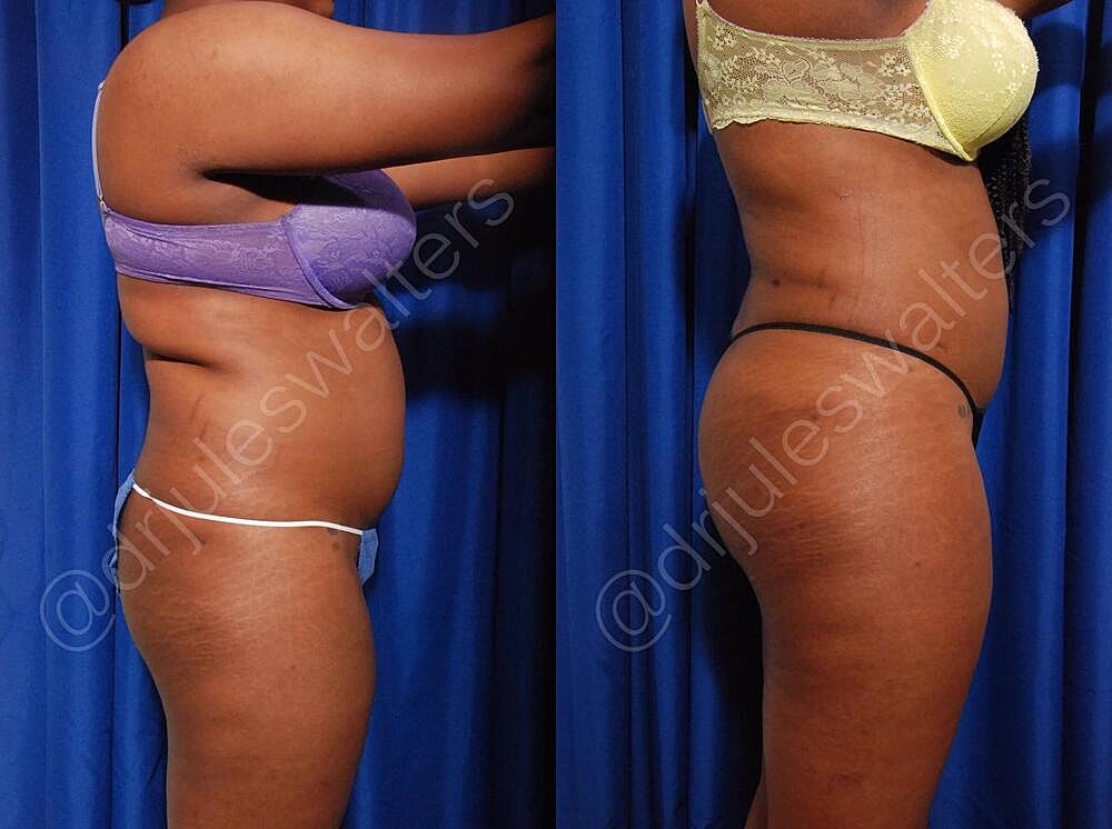 Liposuction Before & After
